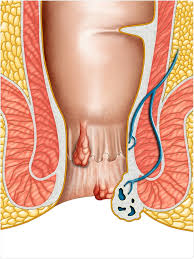 Internal hemorrhoids, also known as inner hemorrhoids or internal piles, are swollen vascular structures that can cause some unpleasant problems, even if you don't feel them. Piles Haemorrhoids In Pregnancy