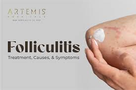 Image result for folliculitis symptoms
