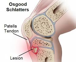 Osgood Schlatter Disease Symptoms Diagnosis Treatment