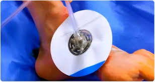 Check spelling or type a new query. What Is Negative Pressure Wound Therapy