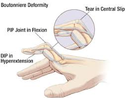 Image result for Elson Extensor Tendon Test