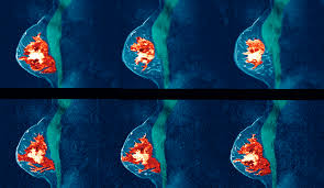 The lymph nodes may or may not contain cancer cells. Study Women With Dense Breast Tissue May Benefit From Regular Mris Time