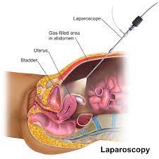 A colonoscopy is a test in which the doctor passes a thin flexible tube through the back passage to have a look at the lining of the large bowel (colon). Laparoscopy Wikipedia