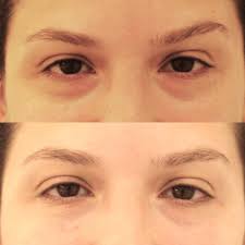 Maybe you would like to learn more about one of these? Dermal Filler Post Procedure Instructions Lara Devgan Md Mph Facs