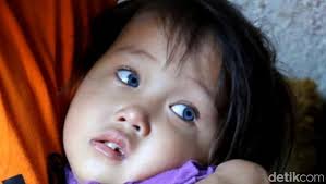 Kata RS Mata Cicendo Soal Mata Bocah Amelia yang Bisa Berubah Warna