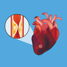 Dunque per cercare di evitare un infarto è bene conoscere i sintomi che lo precedono. Infarto Del Miocardio Infarto Attacco Di Cuore Issalute
