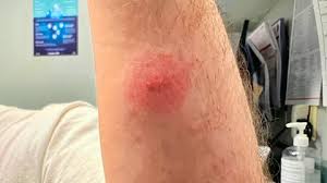 Image result for infected tick bite