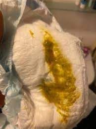 Wer blut im oder auf dem stuhl seines babys findet, macht sich verständlicherweise sorgen um die gesundheit seines kindes. Blut Im Milch Stuhl Achtung Bild Forum Baby Urbia De