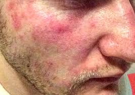 Ihr auslöser sind bestimmte hefepilze der gattung malassezia. Welche Hauterkrankung Kann Das Sein Gesicht Dermatologie Beauty