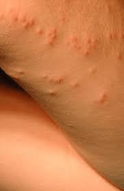 Image result for Cimex lectularius bites