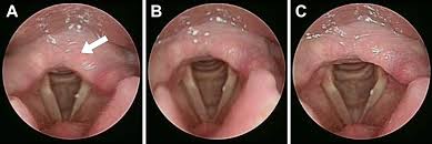 Image result for Reflux Laryngitis