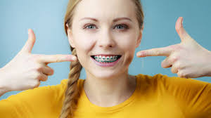 There are multiple reasons why people wear braces. 13 Things You Need To Know About Your First Week With Braces 914 Smiles
