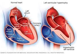 Cardiac arrest is a sudden loss of blood flow resulting from the failure of the heart to pump effectively. Left Ventricular Hypertrophy Symptoms And Causes Mayo Clinic