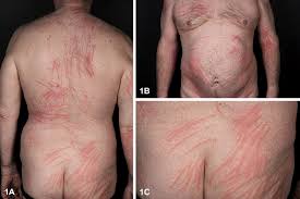 Image result for Linear Dermatitis