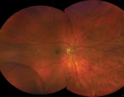 Retinal tears deprive your retina of oxygen, which can lead to permanent damage and vision loss. Can We Pre Empt Damage From Retinal Detachment