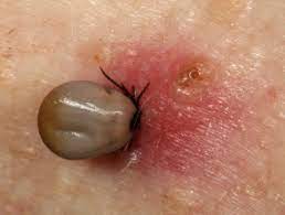 Tick Bites Dermnet Nz