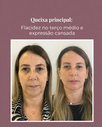 Um lifting natural, com mais sustentação e leveza no olhar — sem bisturi,  sem susto, e do jeitinho que ela queria. Se você também sente que seu rosto  tá pedindo atenção, 📍