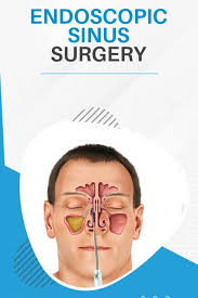 Image result for Sinus Surgery