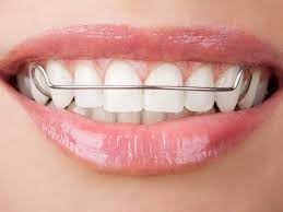 Can You Wear An Old Retainer To Straighten Teeth