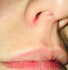 It may look like a pimple or sore just inside the nose. Sore Skin Around Nose Picture Mumsnet