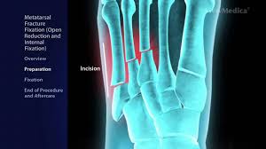 3rd metatarsal stress fracture diagnosis led dathan to. Metatarsal Fracture Fixation Open Reduction Internal Fixation