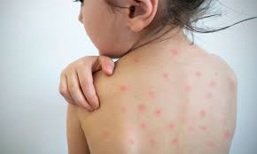 Image result for measles