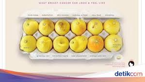 Benjolan ini tidak selalu terasa sakit. Kisah Wanita Dengan Kanker Payudara Dan Foto Lemon Yang Viral