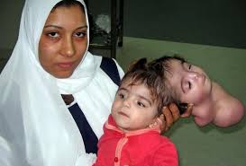 Image result for deformed babies in Iraq caused by depleted uranium