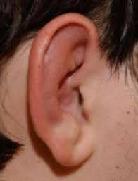 Image result for Relapsing Polychondritis
