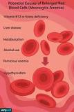 Image result for what is the icd 10 code for macrocytic anemia