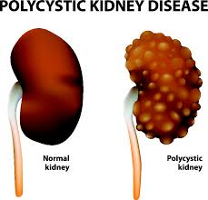 polycystic kidney disease symptoms treatment causes ski