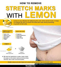 Lemon For Stretch Marks Lemon Is The Best Home Remedy For Treating Stretch Marks Lemon Is A Natural Stretch Marks Treat Stretch Marks Skin Tags Home Remedies