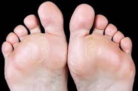 Image result for brown patches on the feet