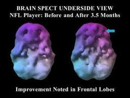 For example you have two lineman knocking in to each other and banging helmets hundreds of times a game or practice compared to an mma fighter who. Abnormally Low Blood Flow Indicates Damage To Nfl Players Brains
