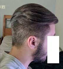 The aad notes that hair shedding—or temporarily losing a little more hair than usual—is completely normal, and usually occurs after a major life stressor or body change, like losing 20 pounds or. Am I Losing My Hair At 20 Years Of Age Hairlosstalk Forums