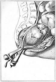 The kielland forceps are probably the most common forceps used for rotation; Obstetrical Forceps Wikipedia