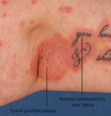 Image result for koebner phenomenon psoriasis