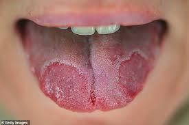 Image result for white cancer on tongue)