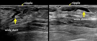 This type of cancer also changes the appearance of your breasts. The Radiology Assistant Ultrasound Of The Breast