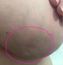 With peau d'orange, the breast swells to the point it causes hair follicles to look like lots of little dimples. Skin Dimpling Sign Of Breast Cancer Health Refs