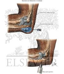 Image result for Elbow Joint Injection