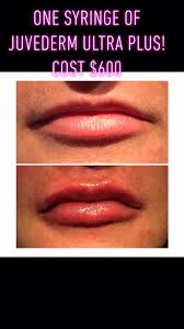 Feb 16, 2021 · radiesse is available in a 1.5, 1.3, 0.8 and 0.3 cc syringe size. One Syringe Of Juvederm Ultra Posh Facial Esthetics Llc Facebook