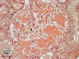 Note the deposits on the saa stain correspond to the location of the congophilic deposits, including subtle tubulointerstitial deposits which will be difficult to find on an h&e stain (arrows). European College Of Veterinary Pathologists April 2008