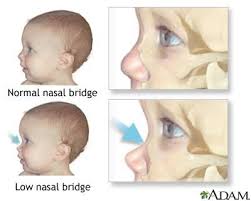 Epicanthic folds is a skin fold on the upper eyelid which covers the inner angle of the eye, which makes them appear smaller and more slanted, even if the eye itself is no different. Low Nasal Bridge And Epicanthic Folds Babycenter