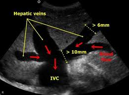 Hepatic Veins Liver Congestion By Right Sided Heart Failure We Find Dialted Peripheral Hepat Sonography Ultrasound Sonography Diagnostic Medical Sonography