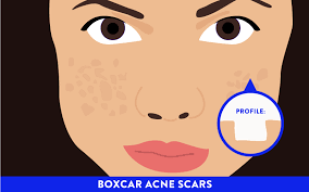 Lemon juice is another best back acne scars treatment. How To Treat Acne Scars Self