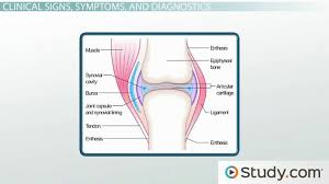 Marfan Syndrome Signs And Management