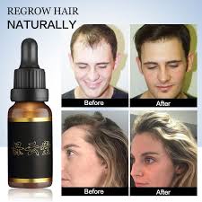 Whether it's illness or other hair loss problems that are causing the. Hair Growth Serum Essence Oil For Fast Hair Growth Anti Hair Loss Treatment Ginger Hair Loss Products For Women Men Hair Tonic Buy At The Price Of 6 69 In Aliexpress Com