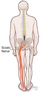Intermediate back muscles and nerve supply: Sciatica Causes Symptoms Treatment Prevention Pain Relief