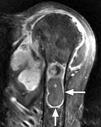 Image result for XRay Changes in Rheumatic Conditions